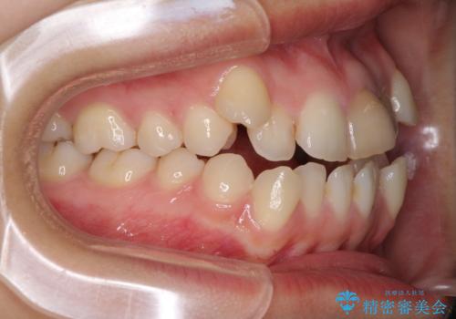 八重歯の抜歯矯正 費用を抑えた矯正装置の治療前