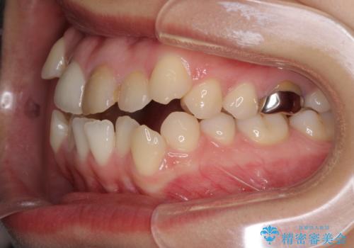 八重歯の抜歯矯正 費用を抑えた矯正装置の治療前