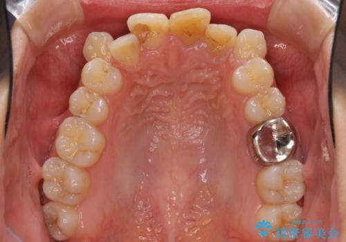 八重歯の抜歯矯正 費用を抑えた矯正装置の治療前