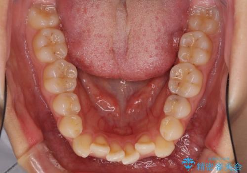 八重歯の抜歯矯正 費用を抑えた矯正装置の治療前