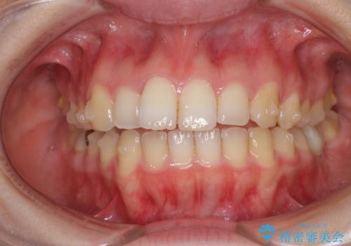 インプラント治療とインビザライン矯正治療 総合歯科治療の治療中