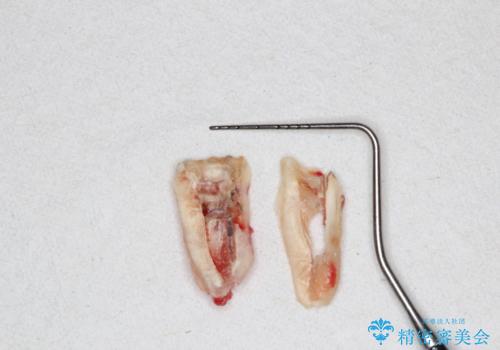 【ヘミセクション】なんとか残したい、割れた奥歯。の治療中