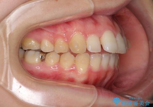 インプラント治療とインビザライン矯正治療 総合歯科治療の治療中