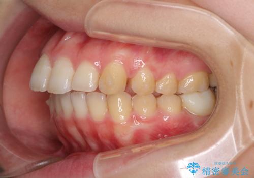 インプラント治療とインビザライン矯正治療 総合歯科治療の治療中