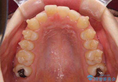インプラント治療とインビザライン矯正治療 総合歯科治療の治療中