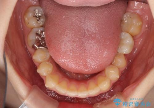 インプラント治療とインビザライン矯正治療 総合歯科治療の治療中