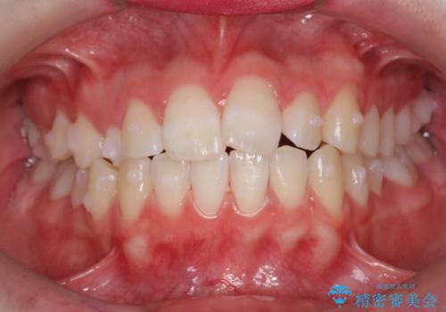 前歯のがたつき 乳歯を抜かずに矯正の治療中