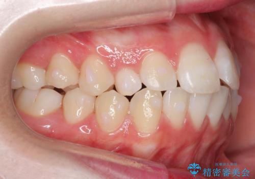 前歯のがたつき 乳歯を抜かずに矯正の治療中