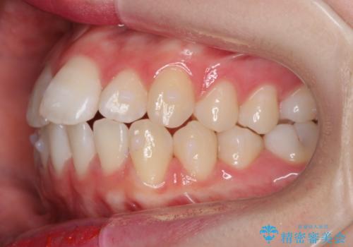 前歯のがたつき　乳歯を抜かずに矯正の治療中