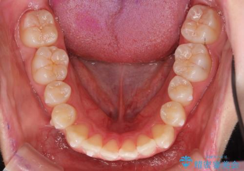 前歯のがたつき 乳歯を抜かずに矯正の治療中