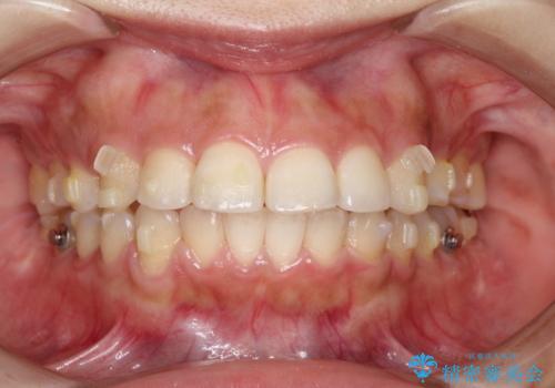矯正治療後の後戻り インビザラインにて再矯正の治療中