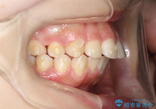 矯正治療後の後戻り インビザラインにて再矯正の治療中