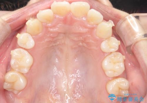 矯正治療後の後戻り インビザラインにて再矯正の治療中