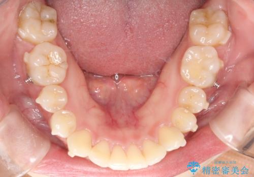 矯正治療後の後戻り インビザラインにて再矯正の治療中