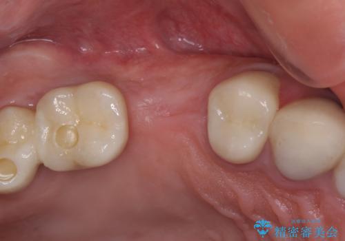 折れてしまった歯 インプラントによる補綴治療の治療中