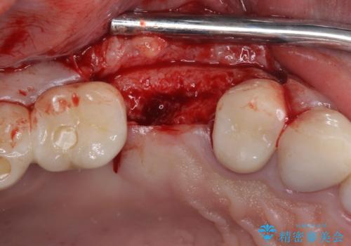 折れてしまった歯 インプラントによる補綴治療の治療後