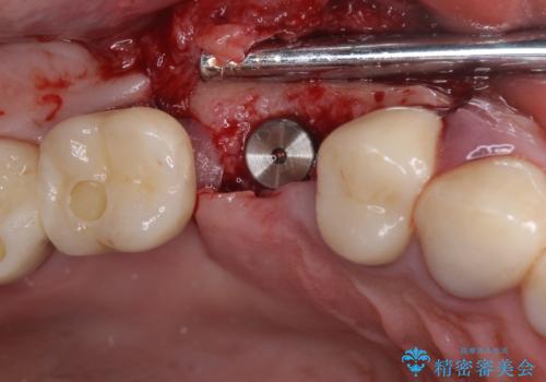 折れてしまった歯 インプラントによる補綴治療の治療前