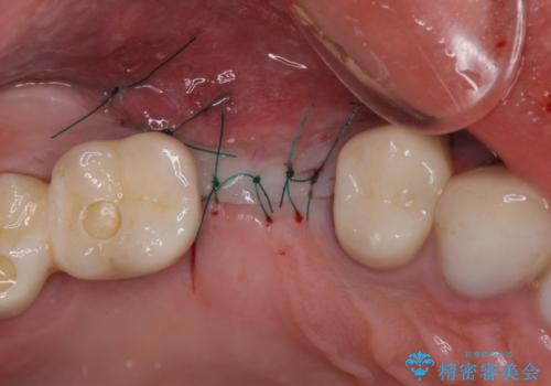 折れてしまった歯 インプラントによる補綴治療の治療中