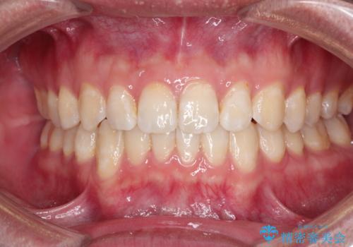 前歯がガタガタ インビザラインによる矯正の治療後