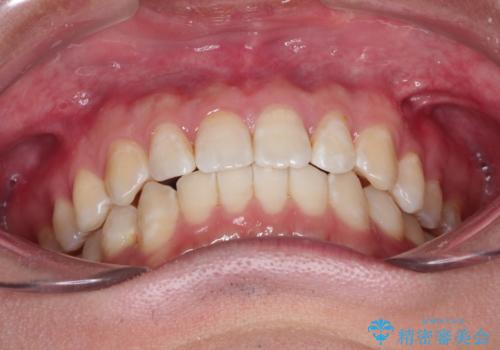 前歯がガタガタ　インビザラインによる矯正の治療後