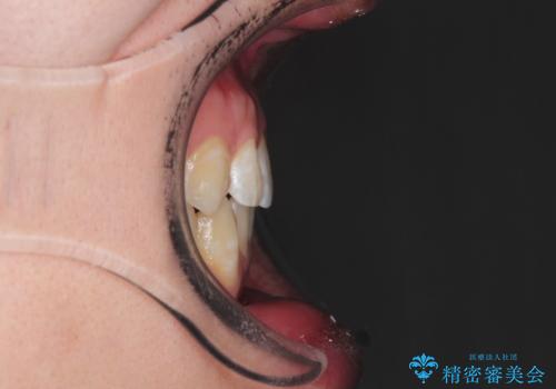 前歯がガタガタ インビザラインによる矯正の治療後