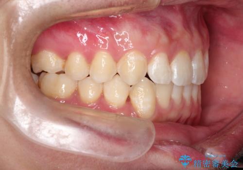 前歯がガタガタ インビザラインによる矯正の治療後