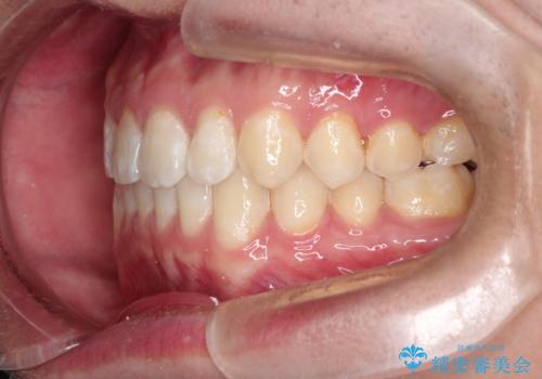 前歯がガタガタ　インビザラインによる矯正の治療後