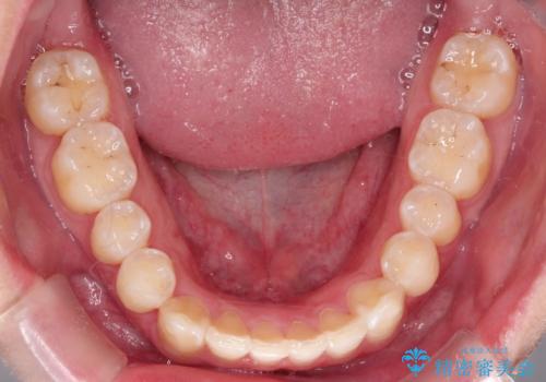 前歯がガタガタ インビザラインによる矯正の治療後