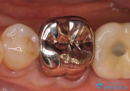 オールセラミッククラウン 咬むと痛む奥歯の根管治療の治療前