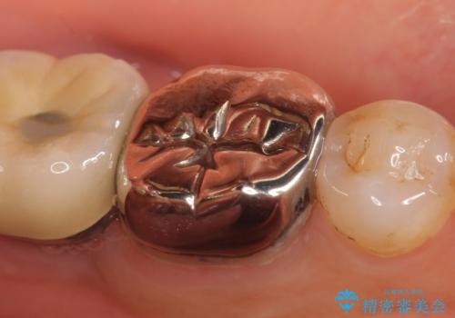 オールセラミッククラウン 咬むと痛む奥歯の根管治療の治療前