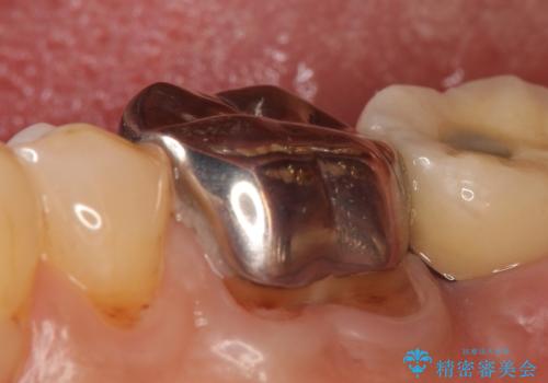 オールセラミッククラウン 咬むと痛む奥歯の根管治療の症例 治療前