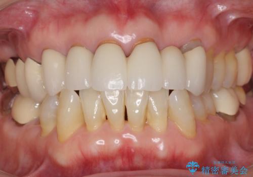 20年前に被せた前歯をやりかえたい 60代女性の治療前