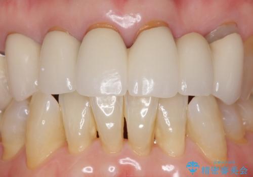20年前に被せた前歯をやりかえたい 60代女性の治療前