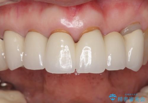 20年前に被せた前歯をやりかえたい 60代女性の治療前