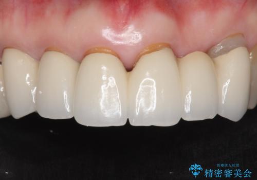 20年前に被せた前歯をやりかえたい 60代女性の治療前