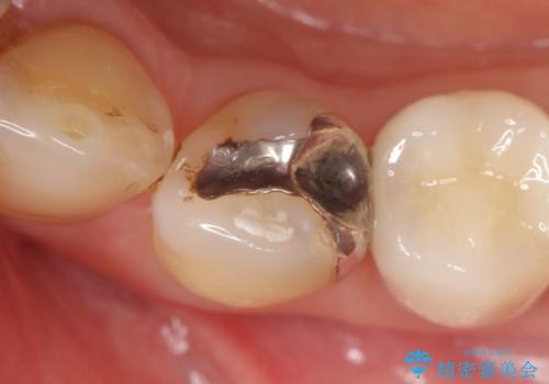 オールセラミッククラウン ズキズキ痛む歯の治療の症例 治療前