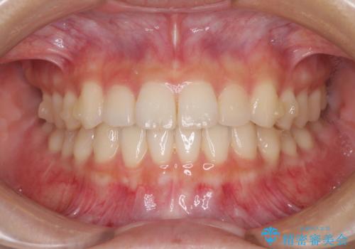 気になる前歯を整えたい インビザライン・ライトでの矯正治療の治療中