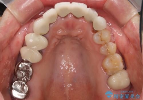 20年前に被せた前歯をやりかえたい 60代女性の治療前