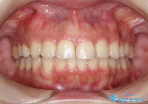 矯正治療後の後戻り インビザラインにて再矯正の治療後