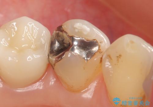 オールセラミッククラウン ズキズキ痛む歯の治療の治療前