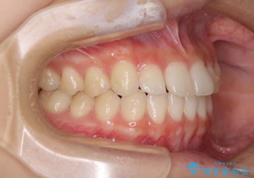 気になる前歯を整えたい インビザライン・ライトでの矯正治療の治療中