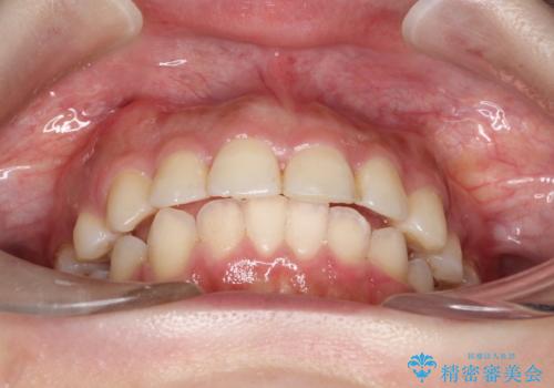 矯正治療後の後戻り インビザラインにて再矯正の治療後