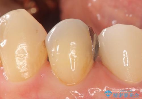 オールセラミッククラウン ズキズキ痛む歯の治療の治療前