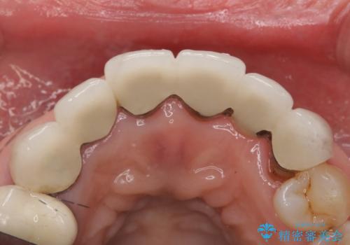 20年前に被せた前歯をやりかえたい 60代女性の治療前