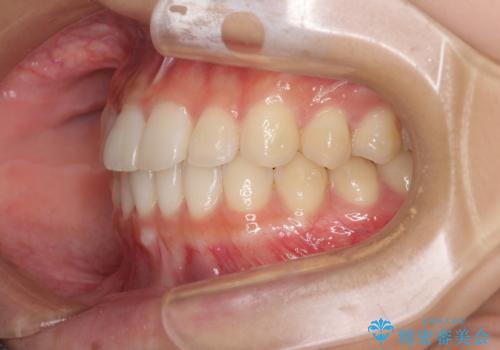 気になる前歯を整えたい インビザライン・ライトでの矯正治療の治療中