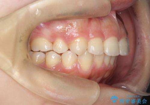 矯正治療後の後戻り インビザラインにて再矯正の治療後