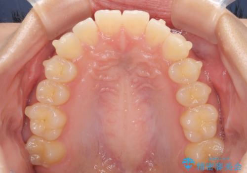 気になる前歯を整えたい インビザライン・ライトでの矯正治療の治療中