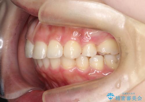 矯正治療後の後戻り インビザラインにて再矯正の治療後