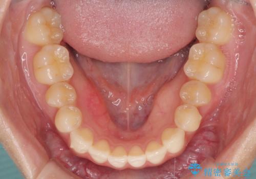 気になる前歯を整えたい インビザライン・ライトでの矯正治療の治療中