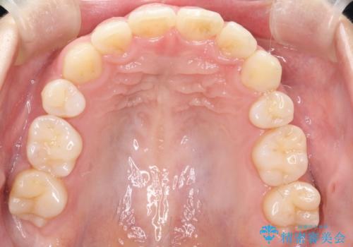 矯正治療後の後戻り インビザラインにて再矯正の治療後